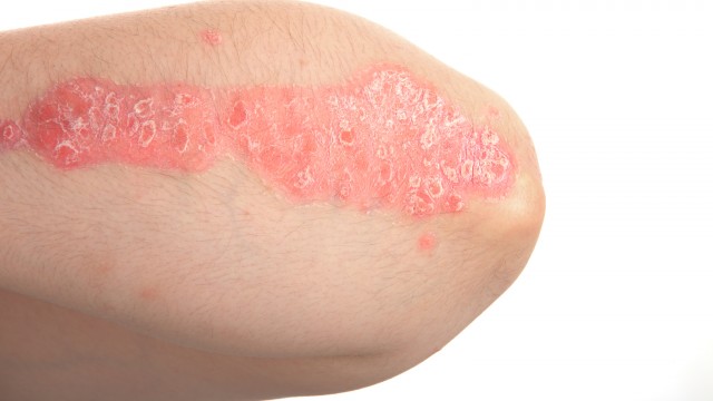 Alumis' $100 Million IPO: Promising Psoriasis Treatment Results