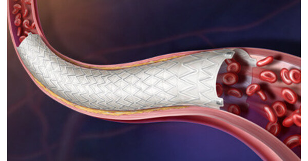 BD Advances Iliac Artery Treatment Across the European Union