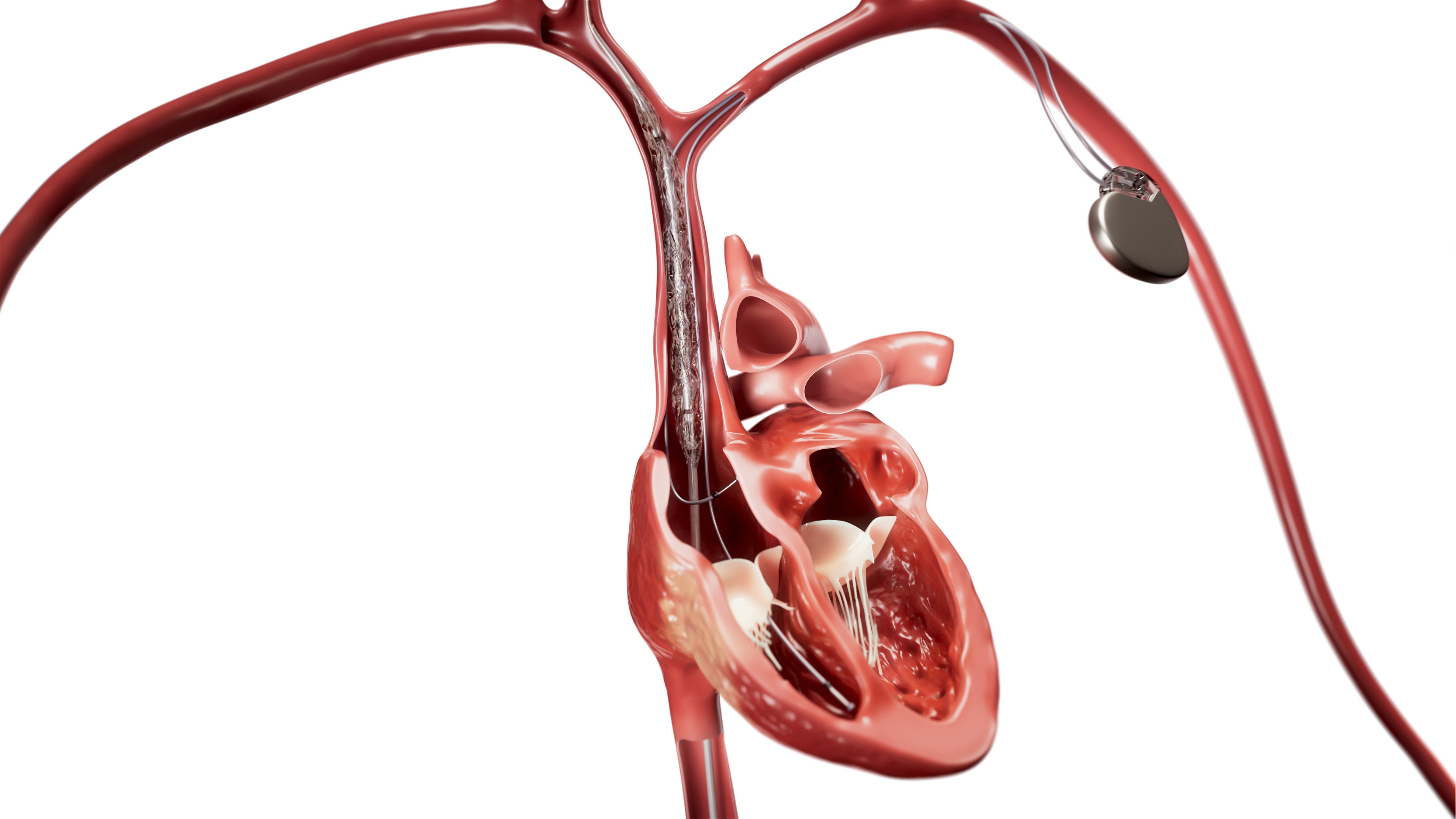 Philips launches new Bridge Plus Occlusion Balloon to help manage rare but life-threatening SVC tears during lead extraction