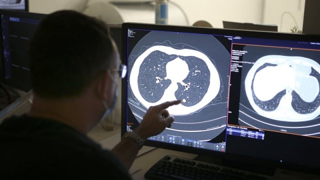 Summit Therapeutics' stock surges as lung-cancer treatment vies with Merck's blockbuster